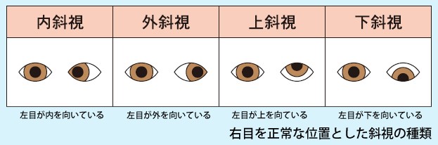 ニューヨーク嶋佐 目 斜視